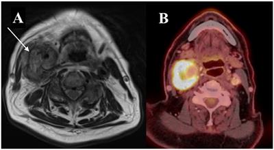 Infected “Mycotic” Aneurysm of the Common Carotid Artery—A Differential Diagnosis to Tumor of the Neck